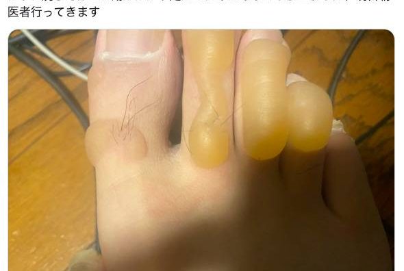 ゆゆうた、カップ焼きそばで足に酷いやけど 「りんご味のグミみてえだ」「やけどはシャレにならんぞ」